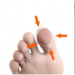 Силиконовые корректирующие подушечки для лечения вросших ногтей.
